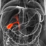 colangiocarcinoma