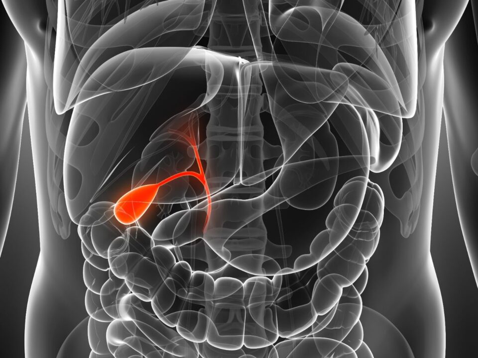 colangiocarcinoma